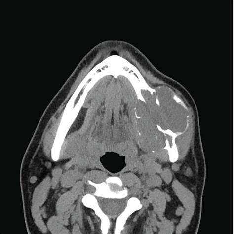 Panoramic Radiograph Revealed A Multilocular Radiolucency In The Body