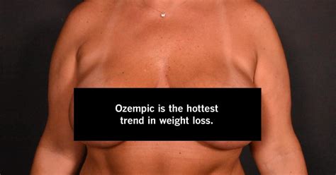 To Fix Ozempic Face And Ozempic Boobs Weight Loss Patients Are Turning To Plastic Surgery