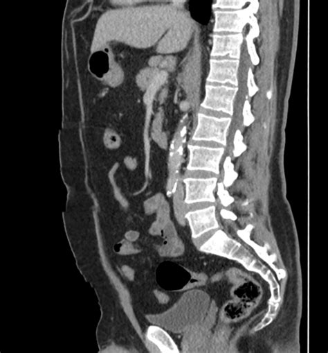 Perforated Gallbladder Empyema With Abscesses Formation Image