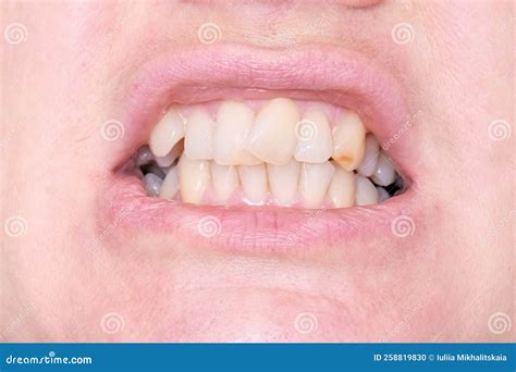 Adult Woman Teeth With Malocclusion Close Up Orthodontic Problem And