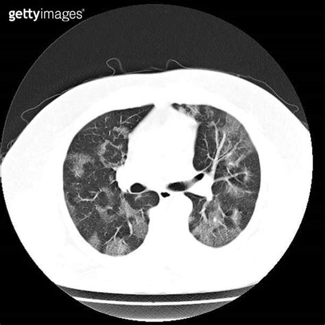 Ct Scan Of The Lung With Viral Pneumonia 이미지 1299974737 게티이미지뱅크