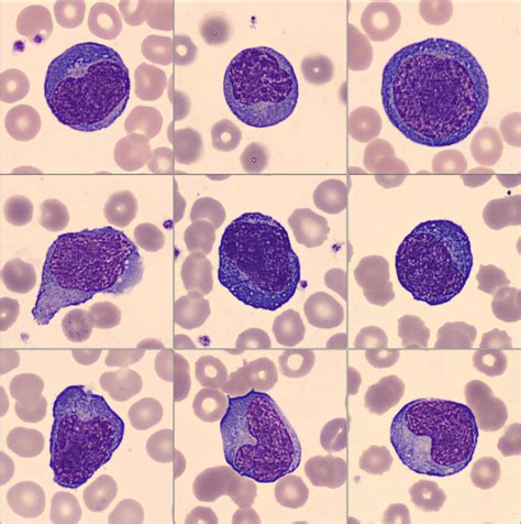 Atypical Lymphocytes Atypical Or Reactive Lymphocytes Are Lymphocytes