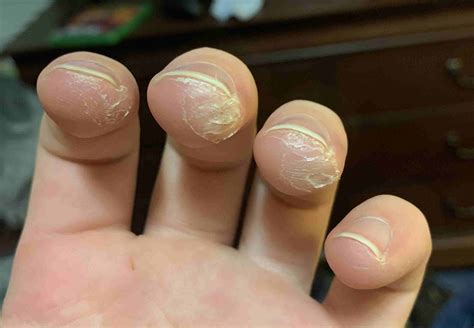 Guitarist Calluses