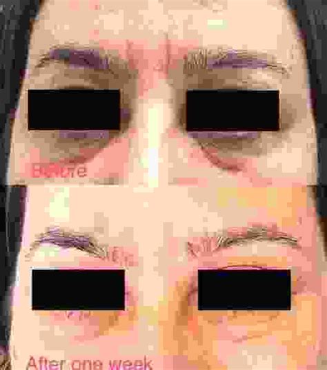 Botox For 11 Lines Before And After One Week Facial Injections Info