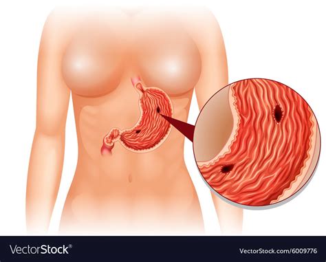 Stomach ulcer diagram in woman Royalty Free Vector Image