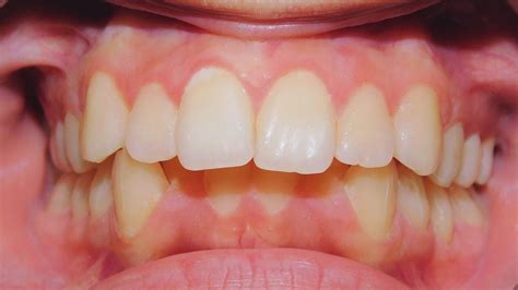 Class Ii Division 1 Malocclusion Excessive Overjet Deep Overbite Proclined And Protruded