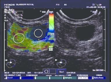 Endoscopic ultrasound image of a malignant appearing lymph node. The ...