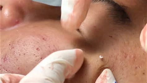 Pimple Popping Video Blackhead Removal Whitehead Removal