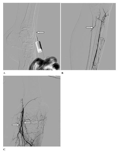 Posterior Tibial Artery Angiogram