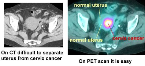 Cancer Cervix Bulky