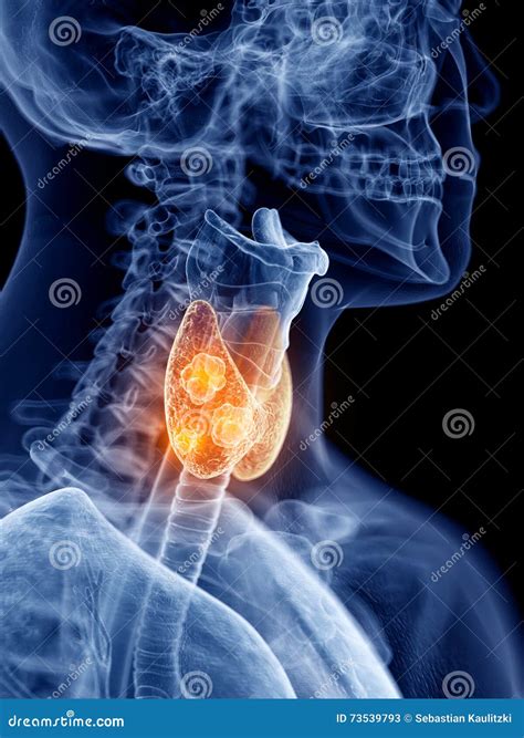 Thyroid Cancer Stages Vector Illustration | CartoonDealer.com #228067904