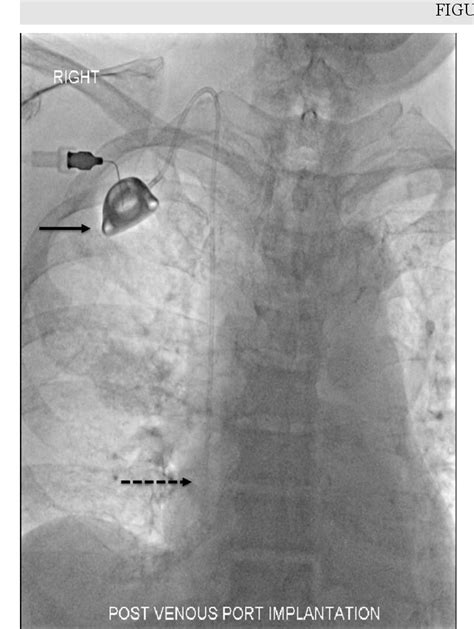 Figure 1 from Infection of a venous port - beware of the Mycobacterium ...