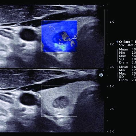 A 53 Year Old Woman With Surgically Proven Papillary Thyroid Carcinoma