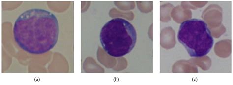 Linfocitosis Concise Medical Knowledge