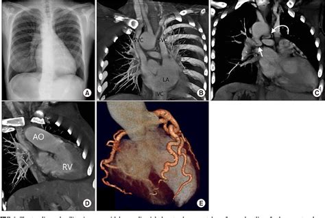 Figure 1 From An Unusual Adult Complex Congenital Heart Disease