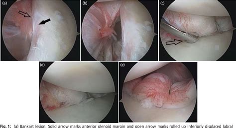 Figure 1 From Retrospective Comparative Analysis Of Clinical And Functional Outcome After