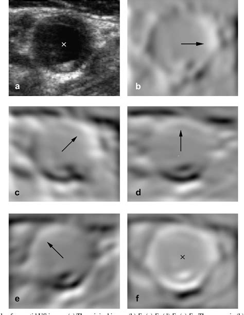 Figure 1 From Three Dimensional Carotid Ultrasound Segmentation Variability Dependence On Signal