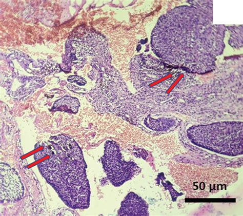 Photomicrograph Showing Nests And Islands Of Basaloid Epithelial Cells