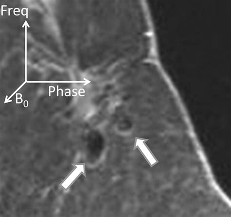 Comparison Of The Artifacts Caused By Metallic Implants In Breast Mri