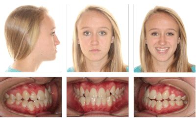 Class Iii Malocclusion Treatment Options Corene Bible