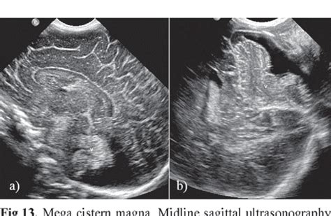 Figure From Neonatal Head Ultrasound Systematic Approach To