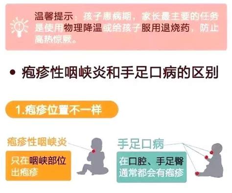 皰疹性咽峽炎就是手足口嗎 淺談兩者的區別 每日頭條