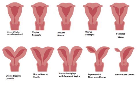 What Is Complete Uterus Didelphys And How Does It Affect Pregnancy In 6