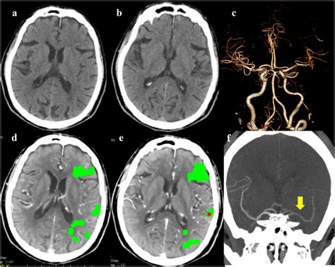 The Emergency Non Contrast CT NCCT A B And Cranial CT Angiography