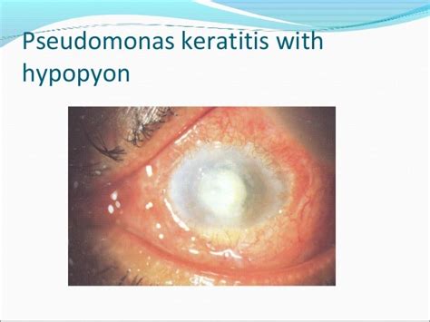 Bacterial Keratitis