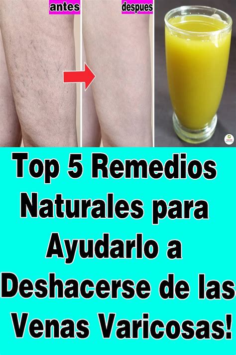 Pin En Remedio Para Las Varices