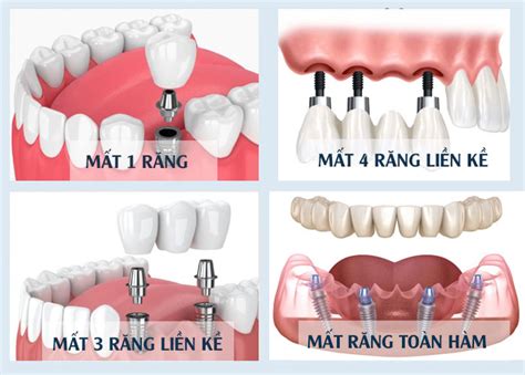 Tr Ng R Ng Implant L G Nh Ng I U C N Bi T Khi C Y Implant