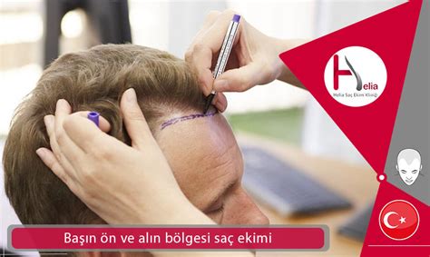 Başın önünde ve alın bölgesi saç ekimi Helia kliniği