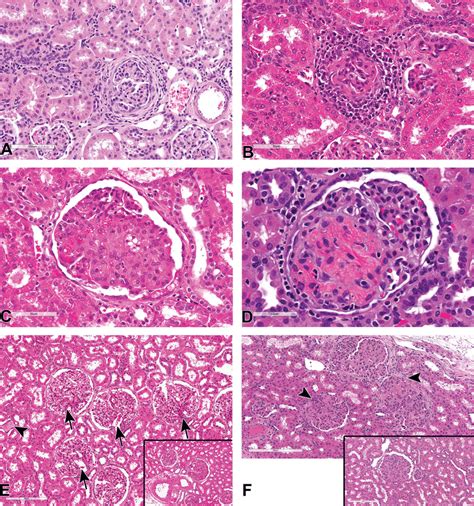 A J Hematoxylin And Eosin Stained Sections Of Glomerular Lesions In