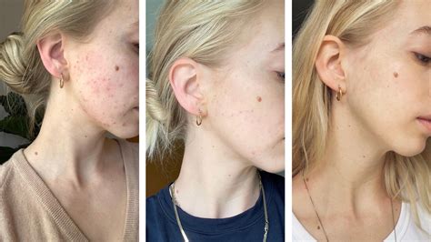 This Is How To Clear Hormonal Acne Once And For All