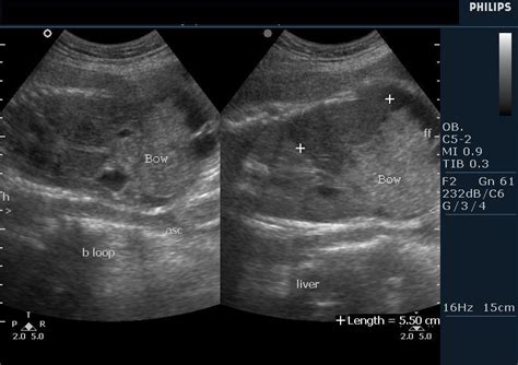 Echogenic Fetal Bowel Ultrasound Services In Ernakulam ID 8454649288