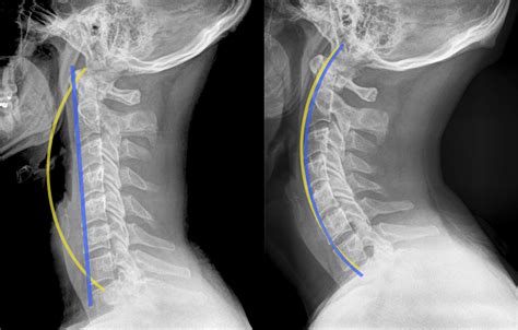 Chiropractic Adjustment Before And After