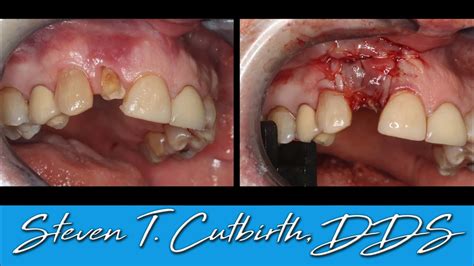 Tooth Extraction Bone Grafting PRF And Suturing Dental Minute With