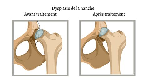 Dr Merini Traumatologue Sp Cialiste De La Dysplasie De La Hanche