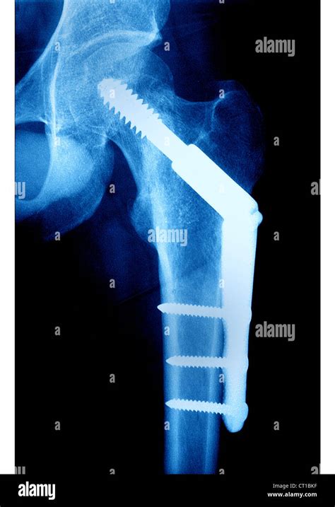 La Osteos Ntesis De F Mur Rayos X Fotograf A De Stock Alamy