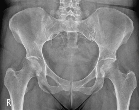 Ap labeled radiograph pelvis Diagram | Quizlet