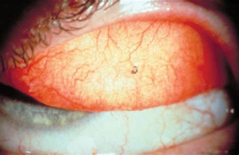 Foreign Body In Eye