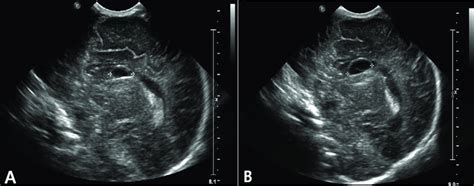 Coronal View Of Head Ultrasonography Shows 1 2 Cm Sized Lt