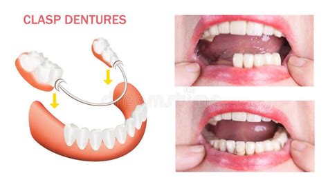 Reabilita O Dental A Pr Tese Superior E Mais Baixa Antes E Depois