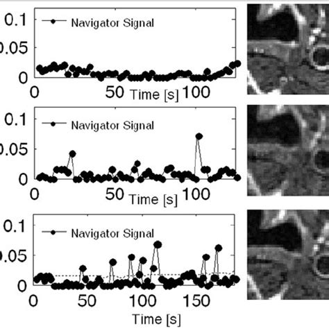 Navigator Signal Left And T2 Weighted Tse Image Right For Reference