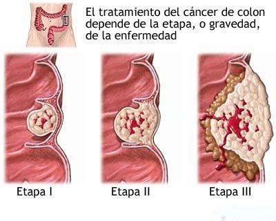 C Ncer De Colon Informaci N M Dica En Ferato Enciclopedia De La