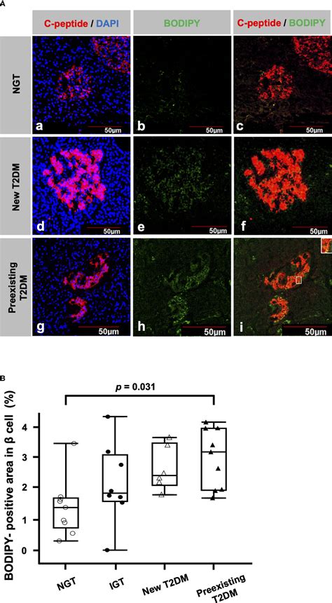 Frontiers Lipid droplet accumulation in β cells in patients with type