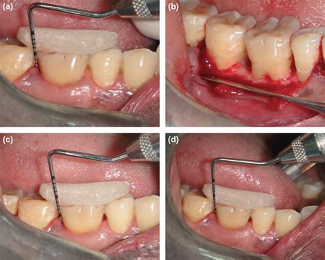 Comparison Of Periodontal Open Flap Debridement Versus Closed