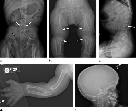 Achondroplasia X Ray Vs Normal