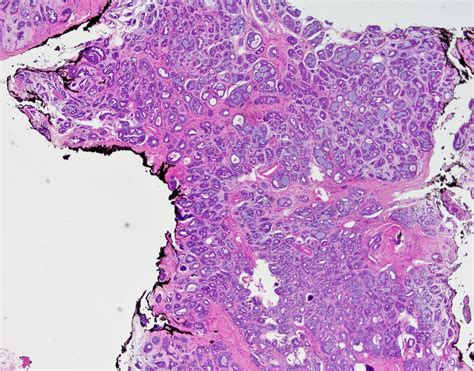 Adenoid Cystic Carcinoma Salivary Gland Global Pathology Teaching And