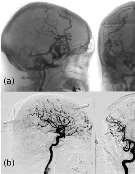 Illustrative Case 2 A 3D RA Of A Ruptured Temporal AVM Spetzler Martin